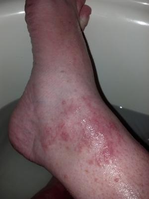 Blistering red skin rash on left ankle