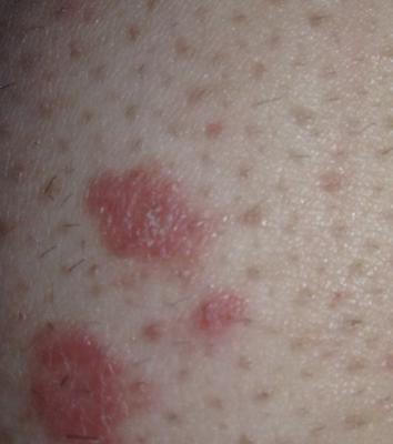 Red blotchy rash on skin.
