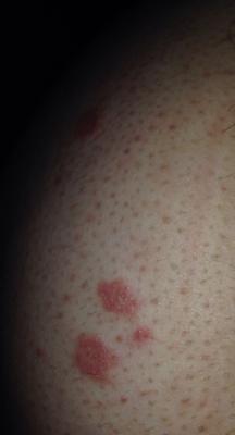 Red blotchy itchy rash on skin.
