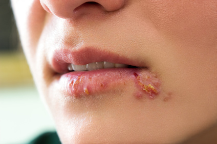 What is a treatment for a blister formation on the lips?