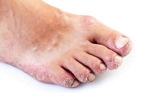 rashes on feet #11