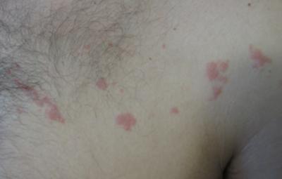 itchy skin rash pictures diagnosis