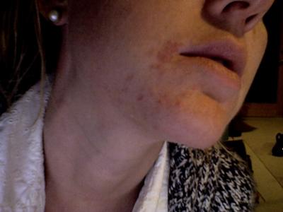 Lamictal Rash on Face