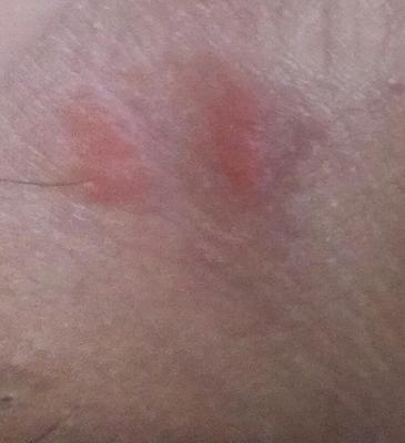 Rash in armpit shingles, pictures, groin, itchy, child ...