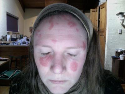 Topical steroid for acne