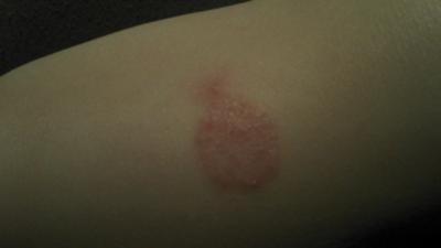 Small slightly raised red circles on skin - Dermatology ...