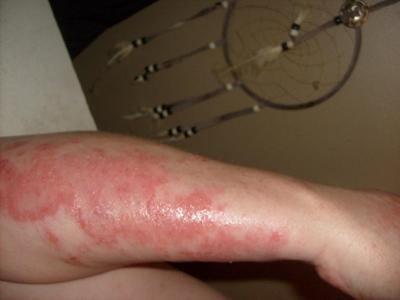 Yeast Rash Arm