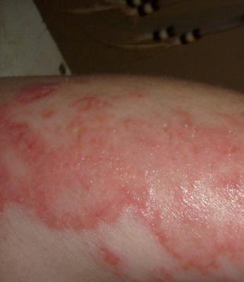 Red Rash Arms Legs 15