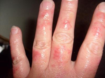 rash on fingertips