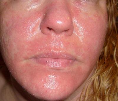 Rash on Face (Facial rash varies) Causes, Symptoms and ...