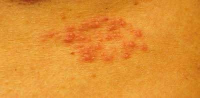 Back rash and Chest rash and Itchy scalp - Right Diagnosis