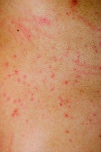 Top 5 Homeopathic Remedies for Skin Rashes , itching and ...