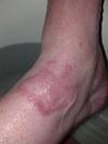 Blistering red skin rash on right ankle