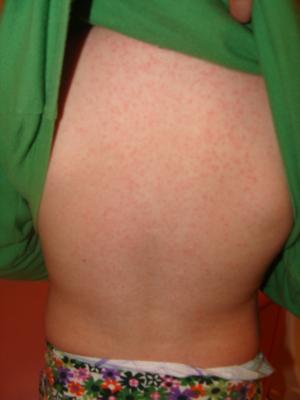 Strep Rash or Viral Scarlatina Rash - Healthy Skin Care