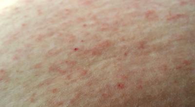 Unknown rash on the skin that has spread.
