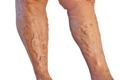 Varicose Veins - Varicose Leg Vein Causes