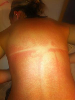 A blotchy skin rash on the back after a day at the beach.