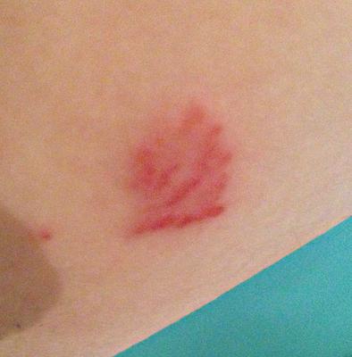 This is the circular itchy red rash by my armpit, 