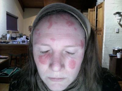 Raised Red Lesions on Face
