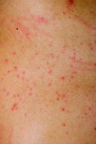 Skin Blotches on the Neck | LIVESTRONG.COM