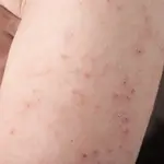 allergic reaction skin rash