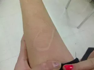 dermatographismleg