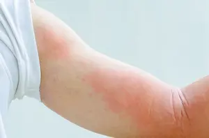 hives on arm