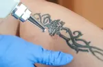 laser tattoo removal