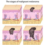 stages of malignant melanoma