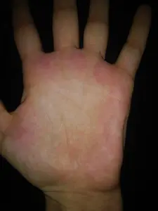 Palm Rash