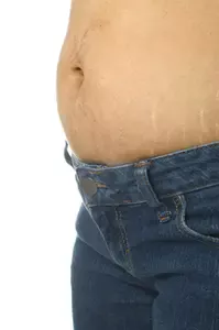 stretch marks on belly