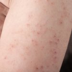 allergic reaction skin rash