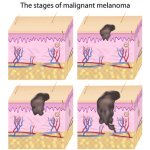 stages of malignant melanoma