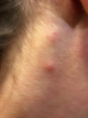 Red itchy pimple on neck.