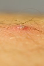 ingrown hair pimple