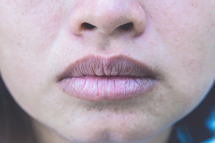 woman with chapped lips
