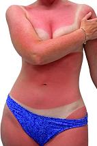 sun tanning and sunburn