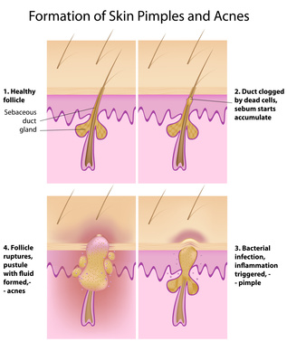 The formation of acne and skin pimples.