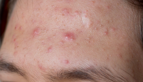 acne pimple skin care problem on forehead