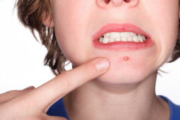 teen with acne skin care problem on face