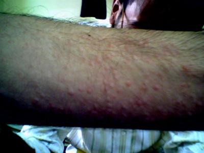 man with red itchy allergic hives on forearm