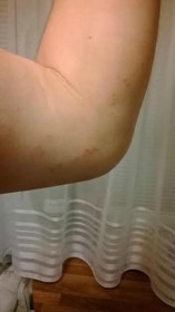 skin rash on arm that is not too itchy