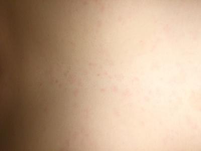 Barely Raised and Non-itchy Red Bumps on Torso Area