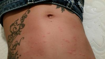 spreading belly rash