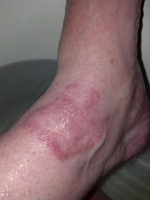 Blistering red skin rash on right ankle