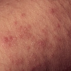 bumpy red rash or hives on skin