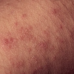 bumpy red rash or hives on skin