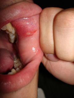 canker sore on lips or in mouth