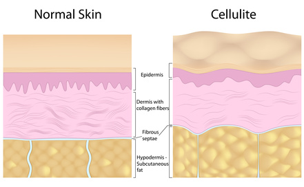 schematic diagram of normal skin layers and skin layer with the cellulite skin problem