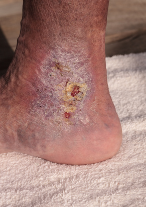 cellulitis infection or staph infection on leg